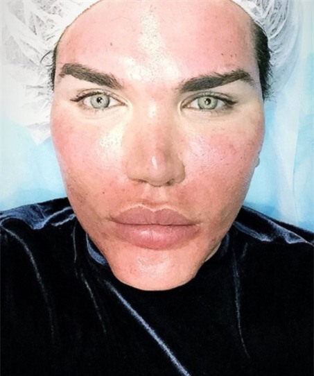 Tiêm filler căng da mặt quá tay, da mặt búp bê Ken phồng rộp như bị bỏng, mũi bị thủng một lỗ - Ảnh 5.