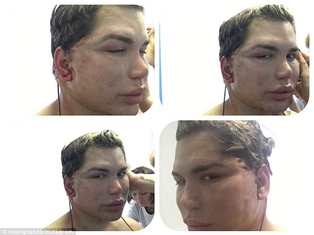 Tiêm filler căng da mặt quá tay, da mặt búp bê Ken phồng rộp như bị bỏng, mũi bị thủng một lỗ - Ảnh 6.