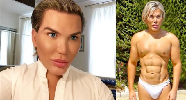 Tiêm filler căng da mặt quá tay, da mặt búp bê Ken phồng rộp như bị bỏng, mũi bị thủng một lỗ - Ảnh 8.