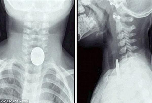 be 2 tuoi suyt tu vong vi nuot phai cuc pin rat pho bien trong do choi tre em - 3