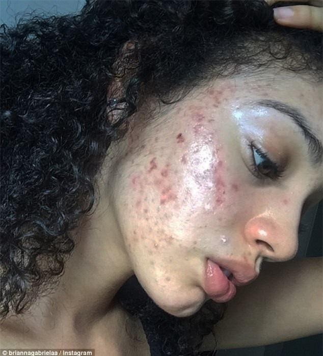 Mặt nát bươm vì mụn trứng cá, cô gái bỗng nổi như cồn trên mạng sau khi chia sẻ cách trị mụn dễ như ăn kẹo - Ảnh 2.