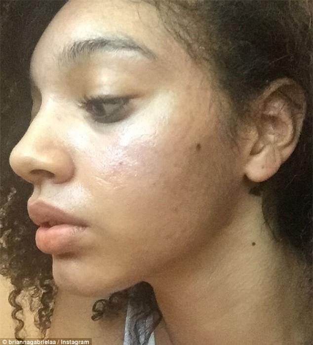 Mặt nát bươm vì mụn trứng cá, cô gái bỗng nổi như cồn trên mạng sau khi chia sẻ cách trị mụn dễ như ăn kẹo - Ảnh 4.