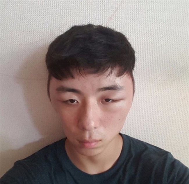 Chết cười với anh chàng Hàn Quốc bị dị ứng thuốc nhuộm tóc, đầu sưng to như quả bóng bay - Ảnh 8.