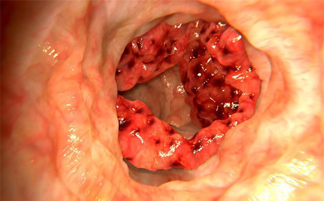 TS Mỹ chỉ 8 dấu hiệu ung thư đại tràng giúp bạn sống lâu hơn-2