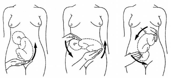 Tròn mắt xem cảnh xoay ngôi thai từ ngược thành thuận thành công-4