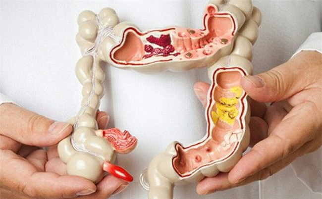 GĐ Trung tâm Ung bướu: Dấu hiệu sớm của ung thư đại trực tràng khi đi ngoài bạn cần chú ý-3