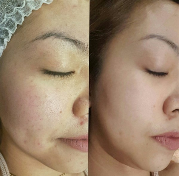 3 xu hướng thẩm mỹ làm đẹp da hot nhất năm 2017 - Ảnh 8.