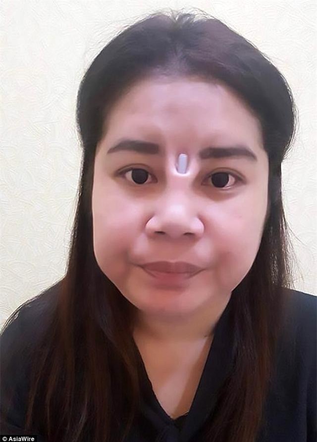 soc nang hinh anh nguoi phu nu phau thuat hong, loi ca silicon mui ra ngoai - 1