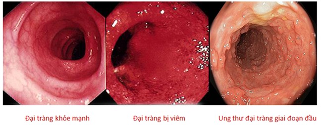 80% người phát hiện mắc ung thư đại tràng ở giai đoạn cuối chỉ vì không làm việc này sớm-2