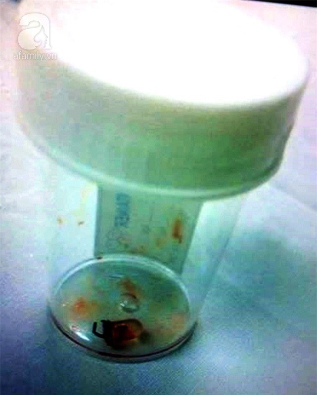 Nuốt đèn led cả năm trời nhưng cha mẹ không biết, bé trai 6 tuổi phải cắt bỏ thùy phổi bên phải - Ảnh 4.