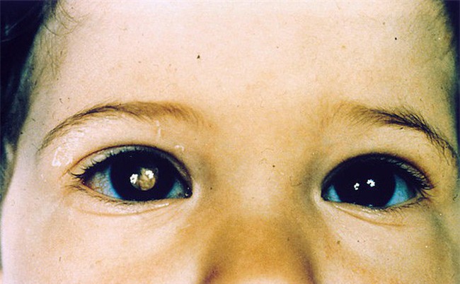 Người phụ nữ thấy sự phản chiếu kỳ lạ trong mắt con, cho đi khám và kết quả đáng sợ-1