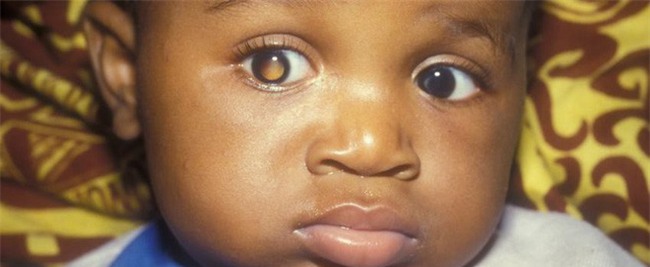 Người phụ nữ thấy sự phản chiếu kỳ lạ trong mắt con, cho đi khám và kết quả đáng sợ-4