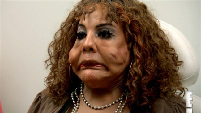 Bị “lang băm thẩm mỹ” bơm xi măng vào mặt, người phụ nữ biến dạng đến mức ai nhìn cũng phát khiếp - Ảnh 2.