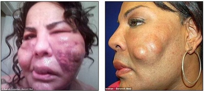 Bị “lang băm thẩm mỹ” bơm xi măng vào mặt, người phụ nữ biến dạng đến mức ai nhìn cũng phát khiếp - Ảnh 3.