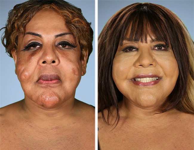 Bị “lang băm thẩm mỹ” bơm xi măng vào mặt, người phụ nữ biến dạng đến mức ai nhìn cũng phát khiếp - Ảnh 6.