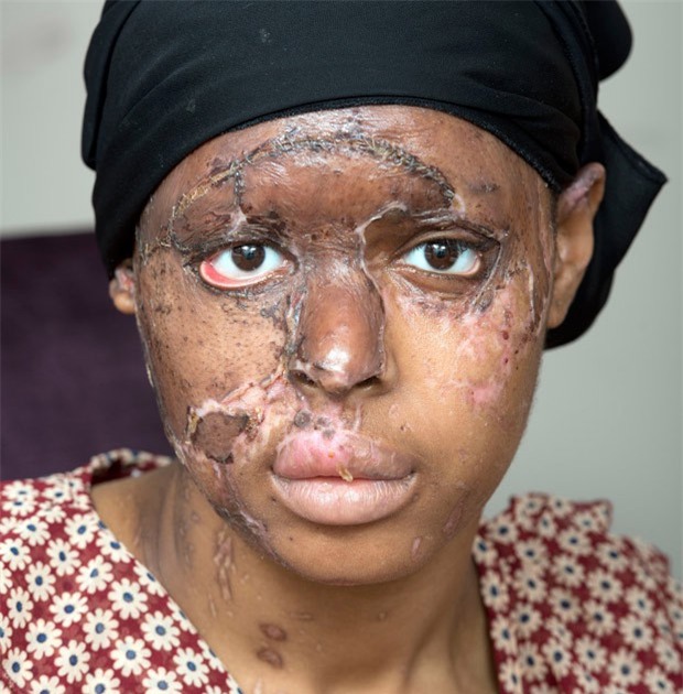 Ghen tị vì bạn thân đẹp hơn mình, cô gái nhẫn tâm dùng axit hủy hoại dung nhan bạn để trả thù - Ảnh 1.