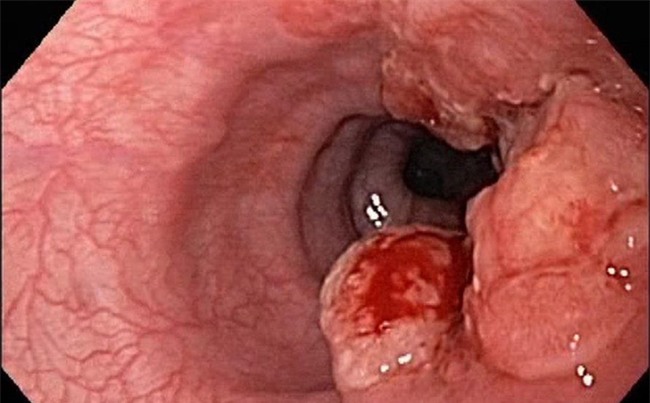 3 thủ phạm gây ung thư thực quản bạn phải biết để từ bỏ sớm-1