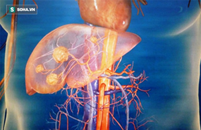 Cảnh giác sớm với 8 hành vi có thể khiến tế bào ung thư gan phát triển nhanh chóng-2