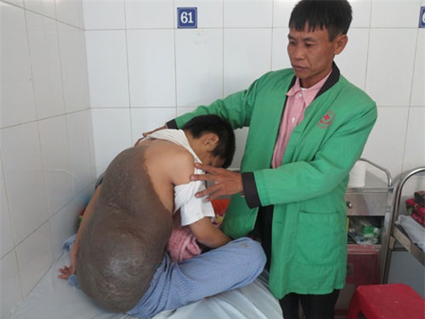 26 năm ngủ ngồi vì khối u nặng 15kg trên lưng-1