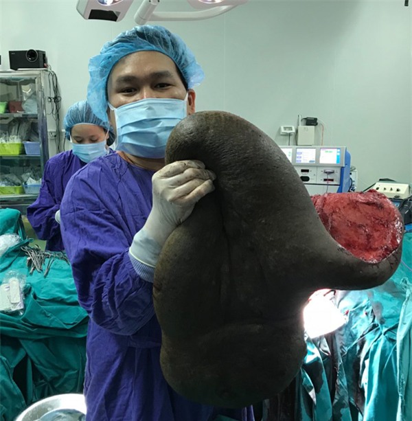 26 năm ngủ ngồi vì khối u nặng 15kg trên lưng-2