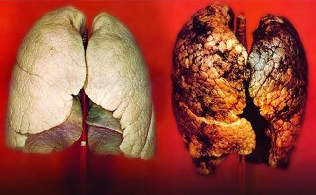 Không hút thuốc lá mà vẫn bị ung thư phổi, chuyên gia xác nhận đây chính là thủ phạm-1