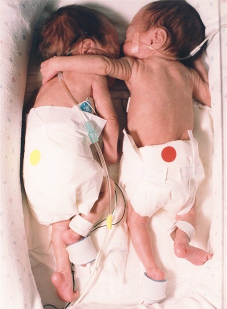 Bất chấp quy tắc, nữ y tá đặt bé sơ sinh hấp hối nằm cạnh chị sinh đôi, tạo nên kết quả chấn động - Ảnh 2.