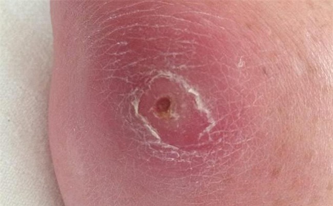 Suýt chết vì 1 vết xước ở tay: Cảnh báo căn bệnh gây tử vong hơn 3 loại ung thư cộng lại-1