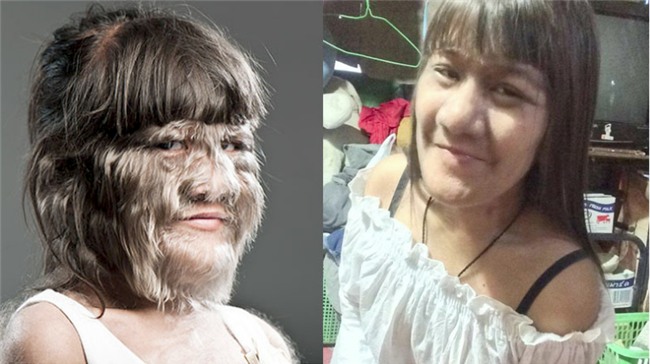 Thái Lan: Cô gái 17 tuổi giữ kỷ lục nhiều lông nhất thế giới khiến mọi người kinh ngạc khi cạo sạch lông mặt! - Ảnh 1.