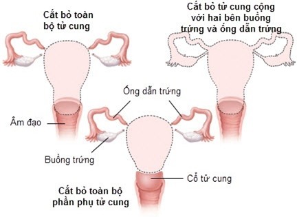 Cắt bỏ tử cung như cựu mẫu Thúy Hạnh có phải nỗi đau đớn lớn nhất của người phụ nữ?-2