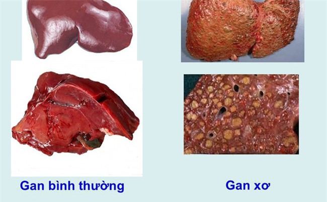 Khi cơ thể cùng lúc xuất hiện 4 dấu hiệu sau, có thể đã là xơ gan giai đoạn cuối-1