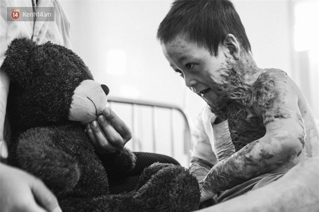 Xót xa những vết bỏng đau đớn trên người bé trai 6 tuổi: Ngày con phải cưa chân là ngày bạn bè vào lớp 1 - Ảnh 5.