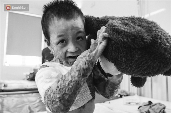 Xót xa những vết bỏng đau đớn trên người bé trai 6 tuổi: Ngày con phải cưa chân là ngày bạn bè vào lớp 1 - Ảnh 5.