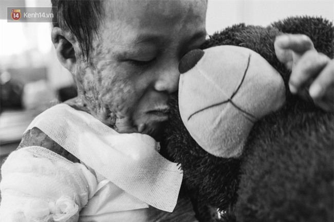 Xót xa những vết bỏng đau đớn trên người bé trai 6 tuổi: Ngày con phải cưa chân là ngày bạn bè vào lớp 1 - Ảnh 5.