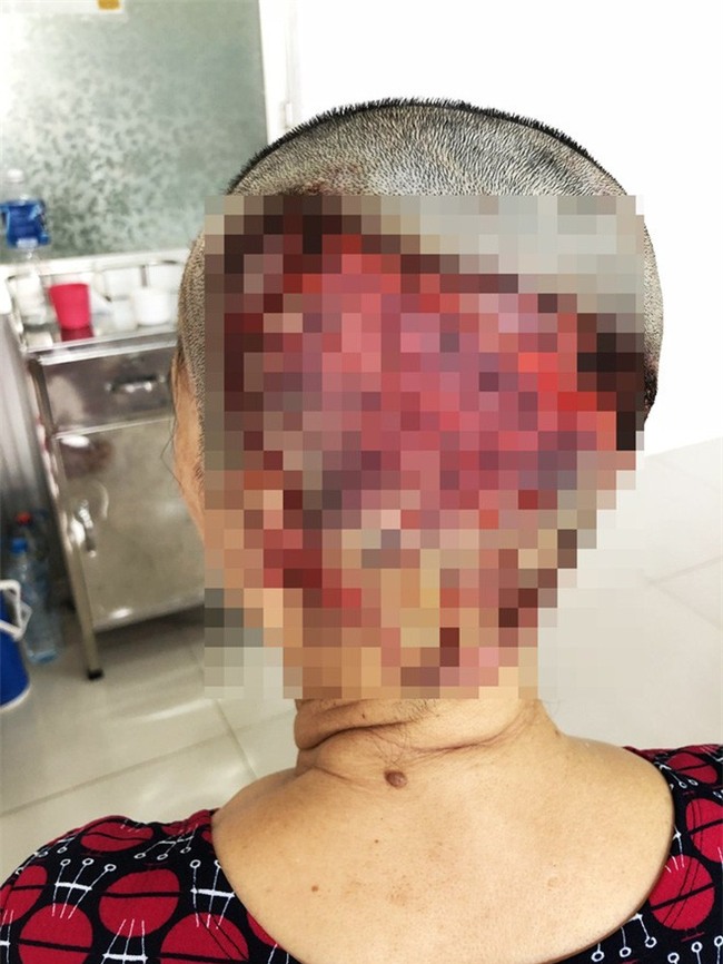 Một phụ nữ Gia Lai hoại tử da đầu nặng, vĩnh viễn không thể mọc tóc sau sự cố làm đẹp kinh hoàng - Ảnh 2.