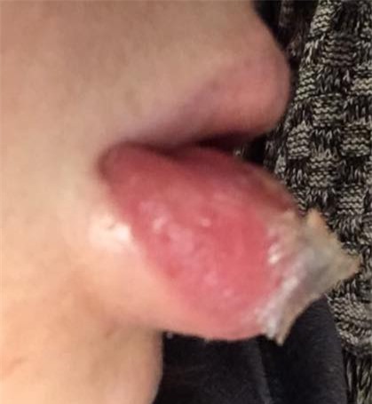 “Tôi chẳng khác gì bước ra từ phim kinh dị”: Người phụ nữ tiêm filler vào môi để làm đẹp, ngờ đâu gặp phản ứng phụ và cái kết đắng - Ảnh 3.