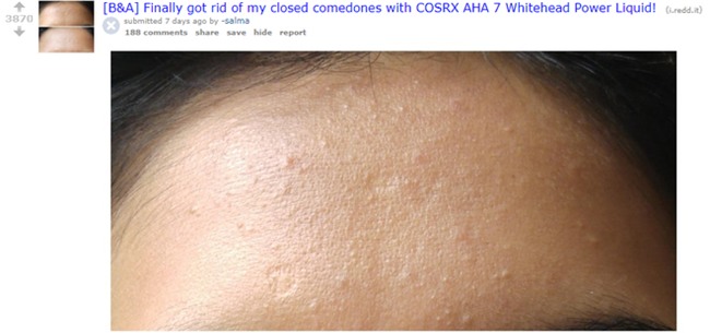 Bị mụn li ti trên trán suốt thời gian dài, cô nàng này không ngờ sản phẩm Hàn Quốc có giá 400k đã cứu rỗi mình - Ảnh 1.