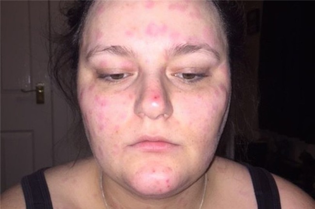 Sắp lên xe hoa, cô gái trẻ phải hoãn đám cưới vì bệnh lạ khiến mặt phồng rộp như bị bỏng-1