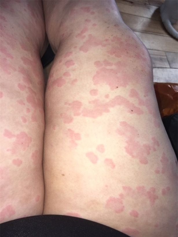 Sắp lên xe hoa, cô gái trẻ phải hoãn đám cưới vì bệnh lạ khiến mặt phồng rộp như bị bỏng-2