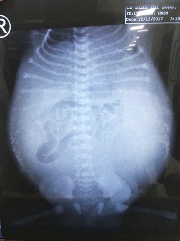 Tưởng không thể qua khỏi, bé trai thủng ruột từ trong bụng mẹ được cứu sống kỳ diệu - Ảnh 2.