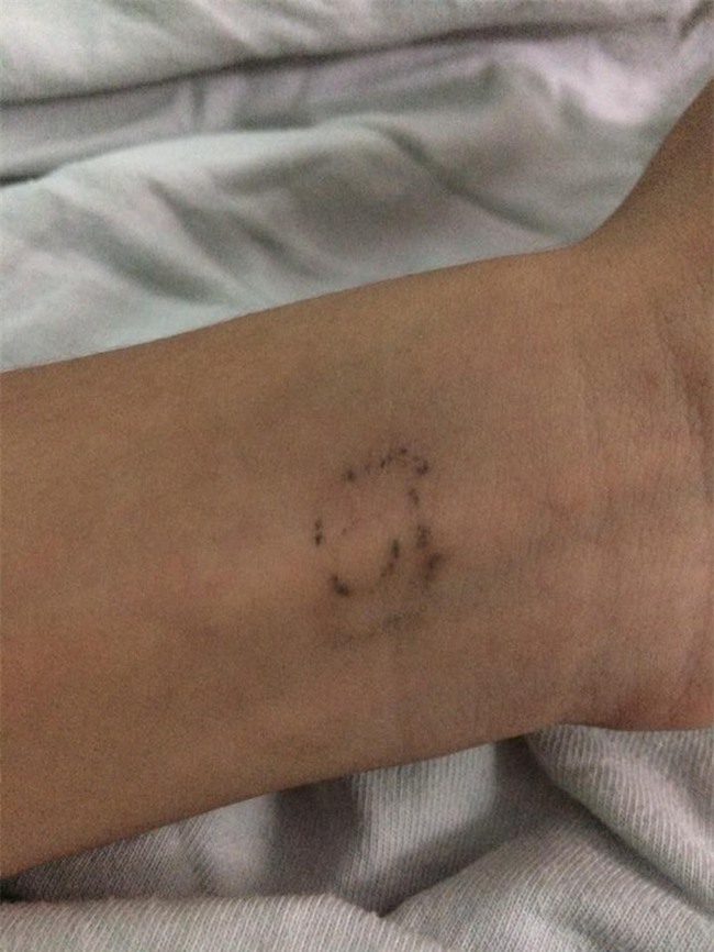 Dân mạng chia sẻ chuyện đi xóa xăm: Đau một lần rồi thôi nhưng để lại vết sẹo xấu xí cả đời - Ảnh 10.