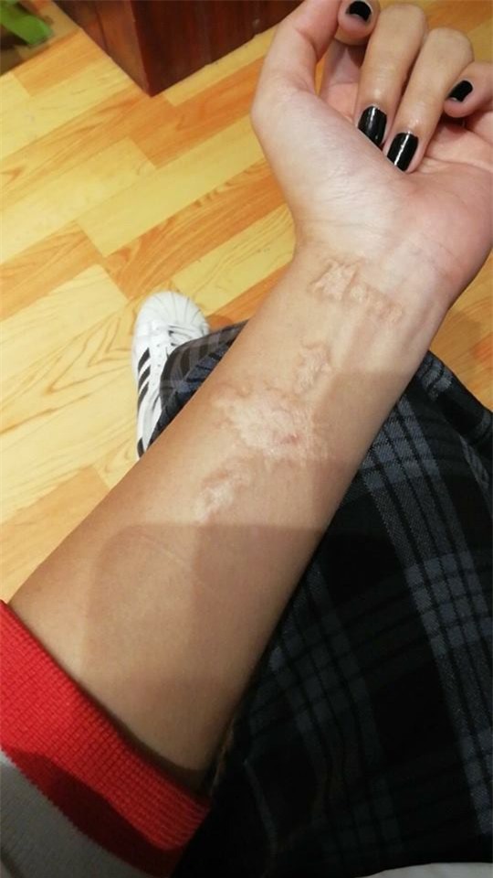 Dân mạng chia sẻ chuyện đi xóa xăm: Đau một lần rồi thôi nhưng để lại vết sẹo xấu xí cả đời - Ảnh 9.