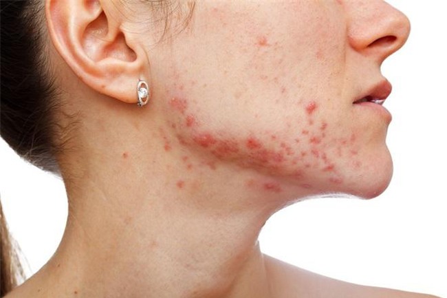 du ket hop nguyen lieu gi voi mat ong cung co the che ra "than duoc" tri mun - 1