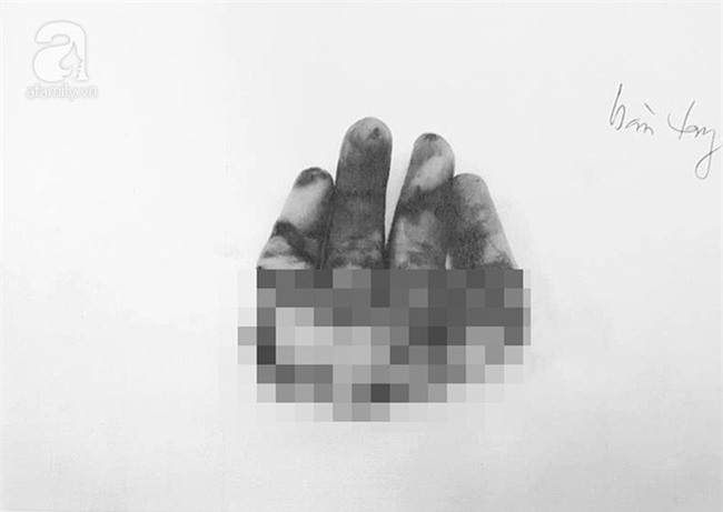 Bình Dương: Bé trai 2 tuổi bị sên xe máy quấn đứt lìa bàn tay - Ảnh 1.