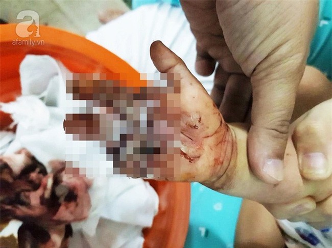 Bình Dương: Bé trai 2 tuổi bị sên xe máy quấn đứt lìa bàn tay - Ảnh 2.