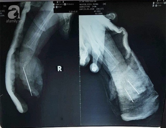 Bình Dương: Bé trai 2 tuổi bị sên xe máy quấn đứt lìa bàn tay - Ảnh 3.