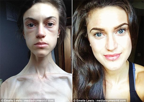 Từng bị gọi là bộ xương di động và nhiều phen tưởng chết, cô gái trẻ 32 kg thay đổi không ai nhận ra - Ảnh 1.