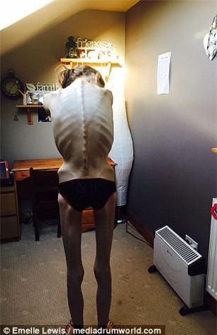 Từng bị gọi là bộ xương di động và nhiều phen tưởng chết, cô gái trẻ 32 kg thay đổi không ai nhận ra - Ảnh 2.