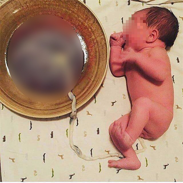 Hà Nội: Thai phụ 18 tuổi đi khám mới phát hiện cửa mình đã mở 3 phân, dây rau thai thắt nút rất nguy hiểm - Ảnh 1.