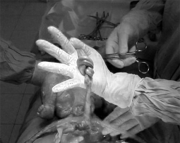 Hà Nội: Thai phụ 18 tuổi đi khám mới phát hiện cửa mình đã mở 3 phân, dây rau thai thắt nút rất nguy hiểm - Ảnh 2.