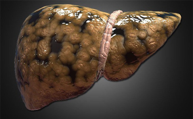 Bệnh gan nhiễm mỡ nguy hiểm như thế nào?-1